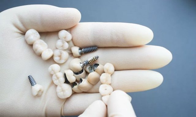 Коронки на зубы: разновидности протезов, их плюсы и минусы, подготовка к установке, проведение процедуры
