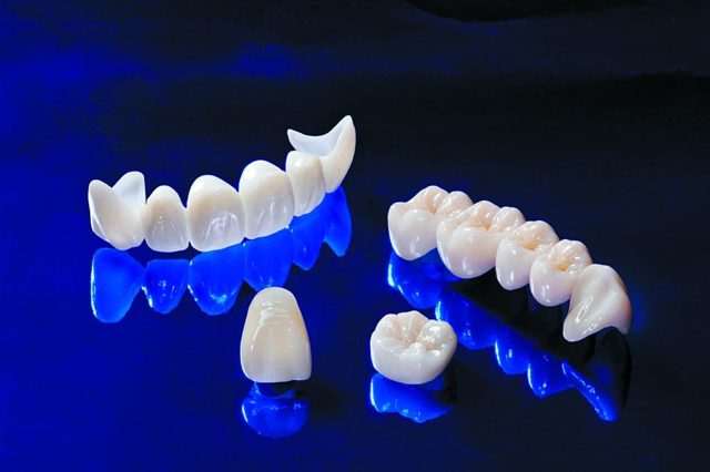 Коронки на зубы: разновидности протезов, их плюсы и минусы, подготовка к установке, проведение процедуры