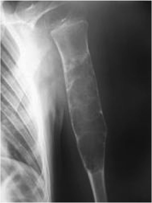 Костная киста плечевой, пяточной, большеберцовой кости, аневризмальная киста кости
