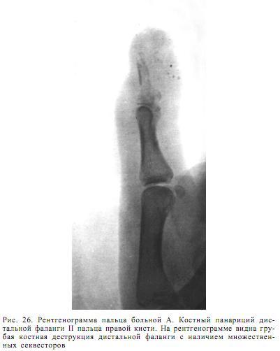 Костный панариций большого пальца кисти: причины возникновения, симптомы и методы лечения с подробными фото
