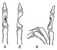Костный панариций большого пальца кисти: причины возникновения, симптомы и методы лечения с подробными фото