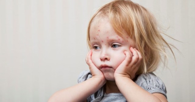 Краснуха у детей: пути передачи, симптомы, лечение и профилактика болезни