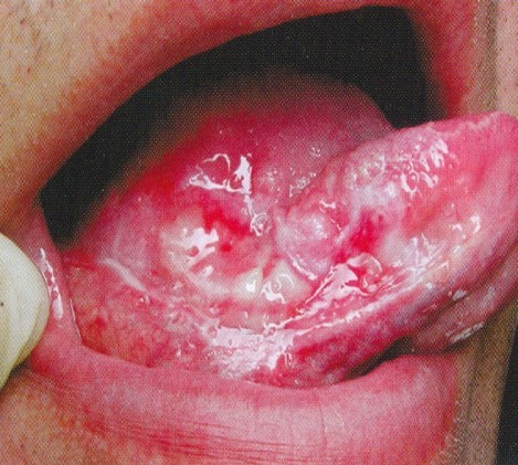 Красный плоский лишай слизистой рта и кожи: фото патологии, специфические симптомы и методы лечения