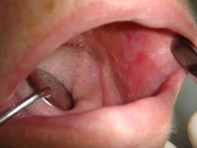 Красный плоский лишай слизистой рта и кожи: фото патологии, специфические симптомы и методы лечения