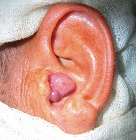 Кровотечение из уха: провоцирующие факторы, тактика лечения и меры профилактики
