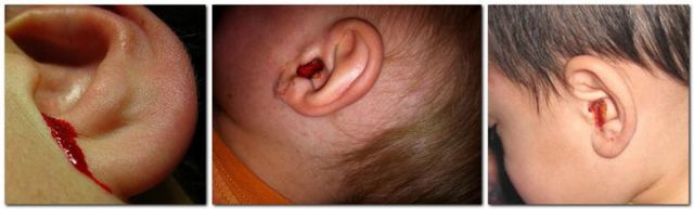 Кровотечение из уха: провоцирующие факторы, тактика лечения и меры профилактики