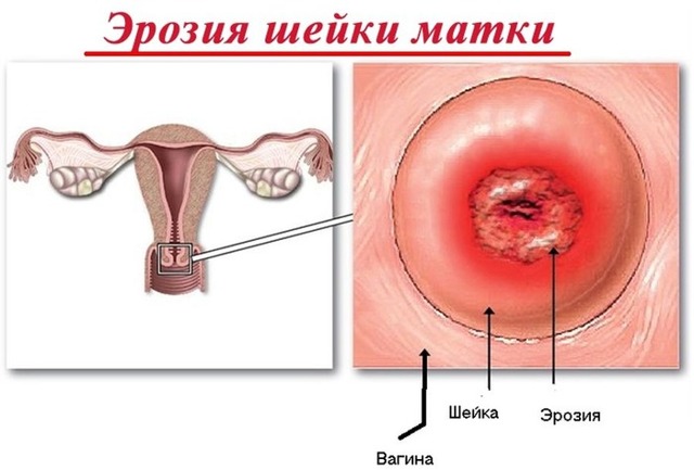 Кровотечение при беременности: прогнозы, возможные осложнения и профилактика. 