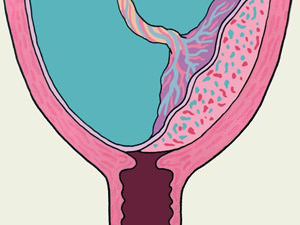 Кровянистые выделения до родов, кровотечение в третьем триместре беременности: что это значит