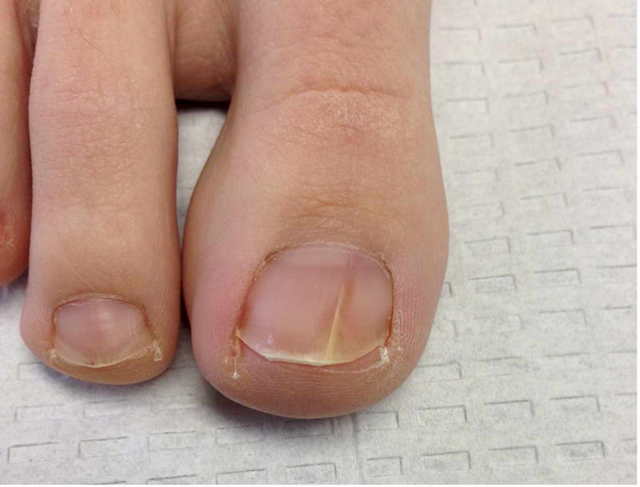 Лаки для ногтей ног и рук от грибка: обзор средств для лечения