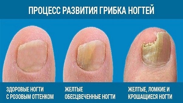 Лаки для ногтей ног и рук от грибка: обзор средств для лечения