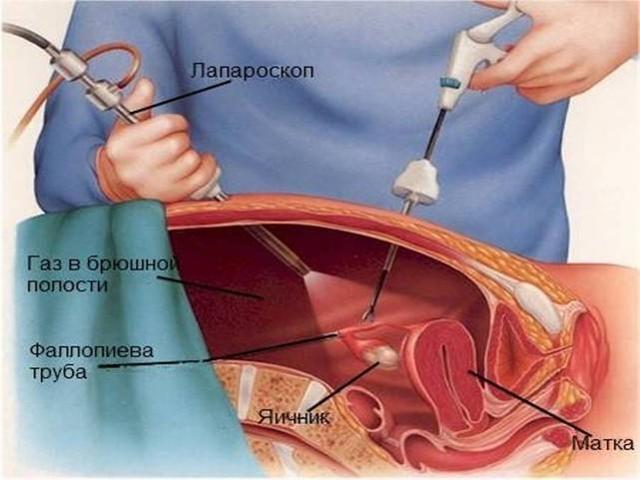 Лапароскопия в гинекологии: показания и противопоказания, правила подготовки, проведение процедуры и восстановление