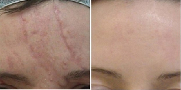 Лазерная шлифовка рубцов на лице и теле: противопоказания, фото до и после