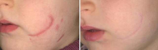 Лазерная шлифовка рубцов на лице и теле: противопоказания, фото до и после