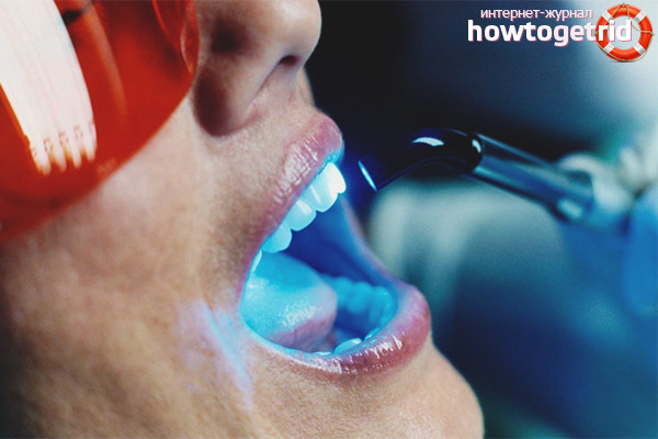 Лазерное отбеливание зубов: плюсы и минусы, отличие от фотоотбеливания