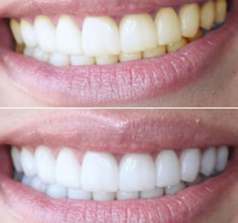 Лазерное отбеливание зубов: плюсы и минусы, отличие от фотоотбеливания