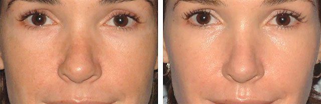 Лазерный пилинг лица: что это такое, противопоказания, фото до и после