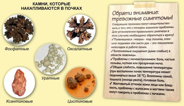 Лечебная диета при оксалатных камнях в почках: общие правила, перечень разрешенных продуктов, варианты меню