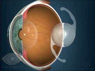 Лечение близорукости: способы восстановления зрения, основные правила, меры безопасности