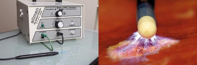 Лечение эрозии шейки матки: прижигание, свечи, радиоволновой, лазерный метод