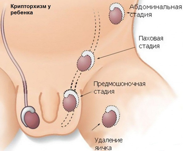 Лечение гипоплазии яичек у мальчиков и мужчин, причины и диагностика патологии