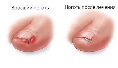 Лечение грибка ногтей лазером при беременности, лекарства