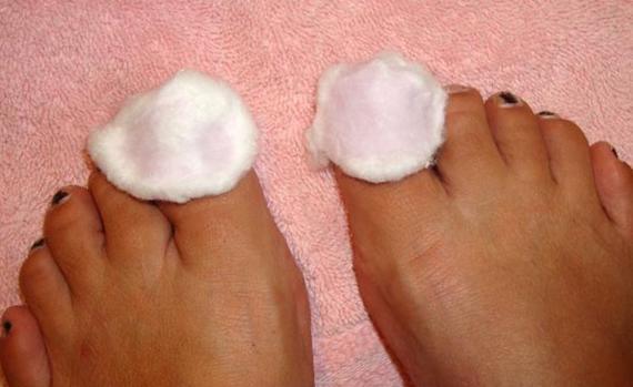 Лечение грибка ногтей на ногах народными средствами: как быстро избавиться