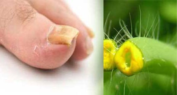 Лечение грибка ногтей на ногах народными средствами: как быстро избавиться