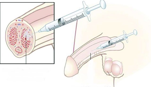 Лечение импотенции интракавернозными инъекциями: уколы при эректильной дисфункции