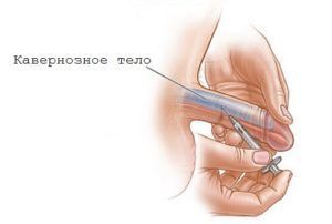 Лечение импотенции интракавернозными инъекциями: уколы при эректильной дисфункции
