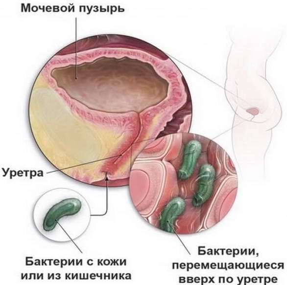 Лечение инфекции мочевыводящих путей у детей до года, симптомы у грудничка