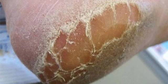 Лечение микозов: как лечить грибок стопы, грибок ногтей, дерматомикоз головы