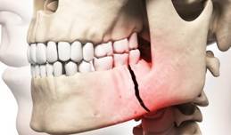 Лечение перелома челюсти: сколько заживает, как проявляется и какие могут быть последствия