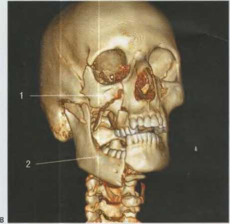 Лечение перелома челюсти: сколько заживает, как проявляется и какие могут быть последствия