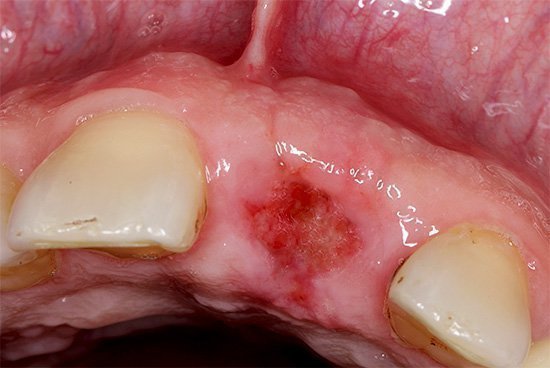 Лечение после удаления зуба: чем полоскать для быстрого заживления