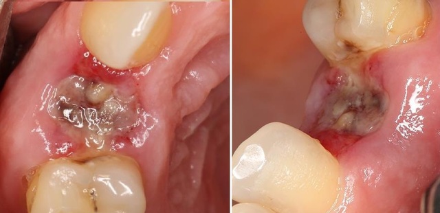 Лечение после удаления зуба: чем полоскать для быстрого заживления