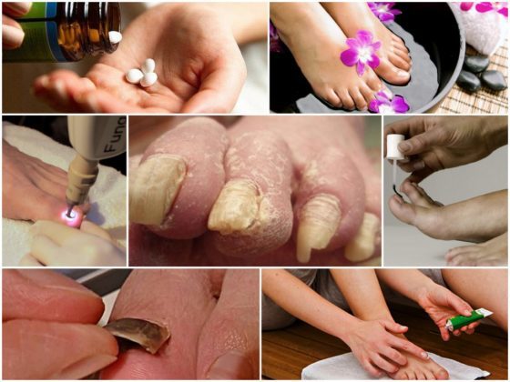 Лечение запущенного грибка ногтей: эффективные средства для лечения
