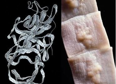 Ленточные черви у человека: бычий цепень, широкий лентец, свиной цепень, эхинококк
