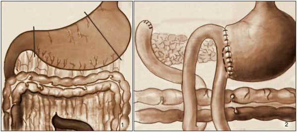 Лейомиома желудка: причины развития, клинические проявления, методы лечения и профилактика