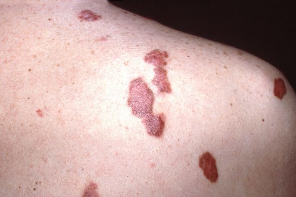 Лейомиосаркома кожи: причины возникновения, типичные признаки, принципы лечения и прогноз