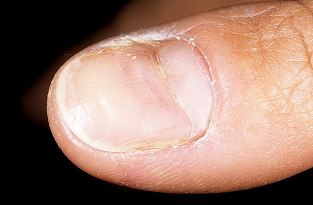 Линии Бо-Рейля на ногтях, борозды на ногтевой пластине: как выглядят, почему появляются, лечение