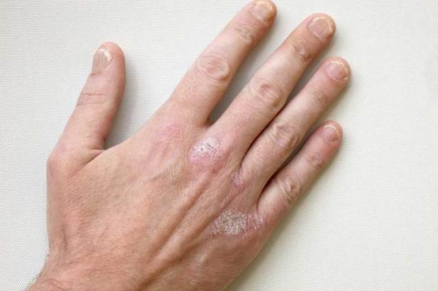Линии Бо-Рейля на ногтях, борозды на ногтевой пластине: как выглядят, почему появляются, лечение