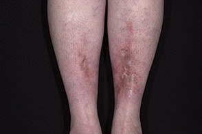 Липоидный некробиоз кожи: факторы риска, клинические проявления, диагностика и принципы лечения
