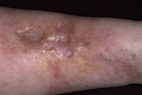 Липоидный некробиоз кожи: факторы риска, клинические проявления, диагностика и принципы лечения