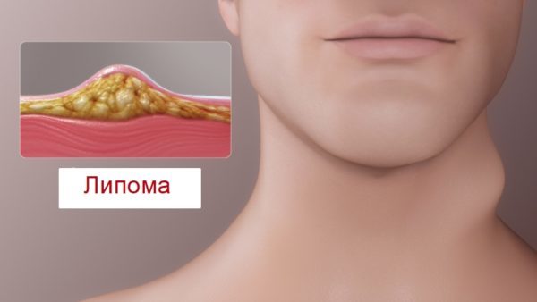 Липома гортани: причины образований, характерные симптомы, диагностика и способы лечения