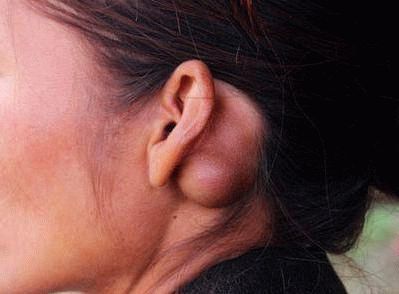 Липома уха: факторы риска развития, типичные симптомы, способы лечения и возможные осложнения