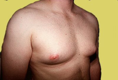 Липомастия у мужчин: что это такое, фото, как лечат, влияние диеты и спорта