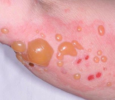 Листовидная пузырчатка: причины развития, характерные признаки заболевания с подробными фото, эффективные методы лечения