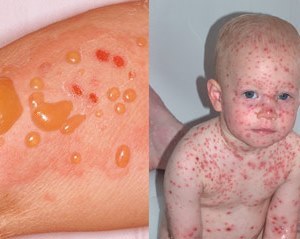 Листовидная пузырчатка: причины развития, характерные признаки заболевания с подробными фото, эффективные методы лечения