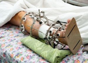 Ложный сустав после перелома: причины формирования, характерные признаки, методы обследования и принципы лечения
