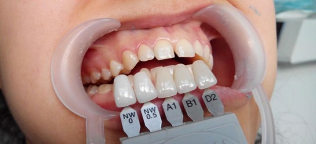 Люминиры на зубы: что это такое, в каких случаях применяется, отличия от виниров, этапы процедуры, преимущества